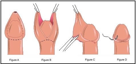 Phương pháp điều trị dài bao quy đầu hiệu quả