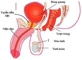 Bệnh viêm tiền liệt tuyến mãn tính