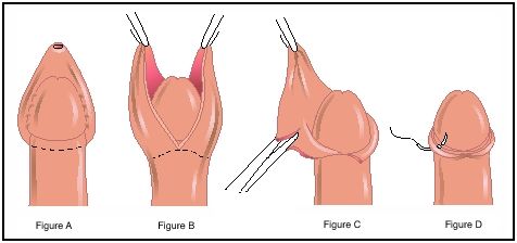 Cắt bao quy đầu thẩm mỹ