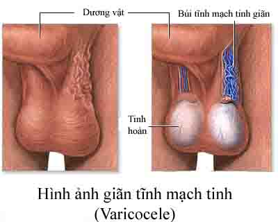 Nguy hại của giãn tĩnh mạch thừng tinh đến sức khỏe nam giới