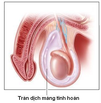 Hiện tượng tràn dịch màng tinh hoàn