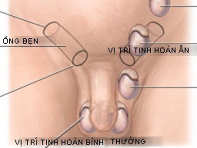 Tinh hoàn ẩn là nguyên nhân gây vô sinh